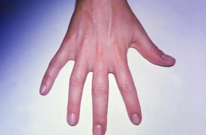 Managing arthritis pain at night