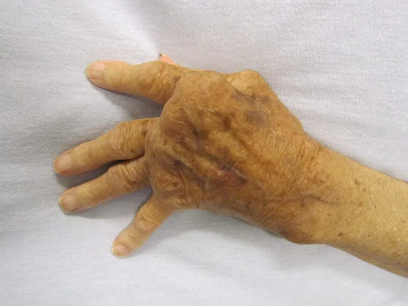 Rheumatoid arthritis joint inflammation