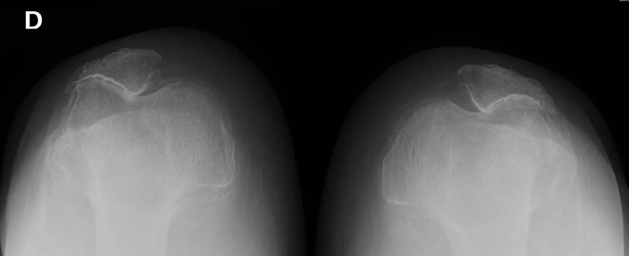 Fibromyalgia functional impact