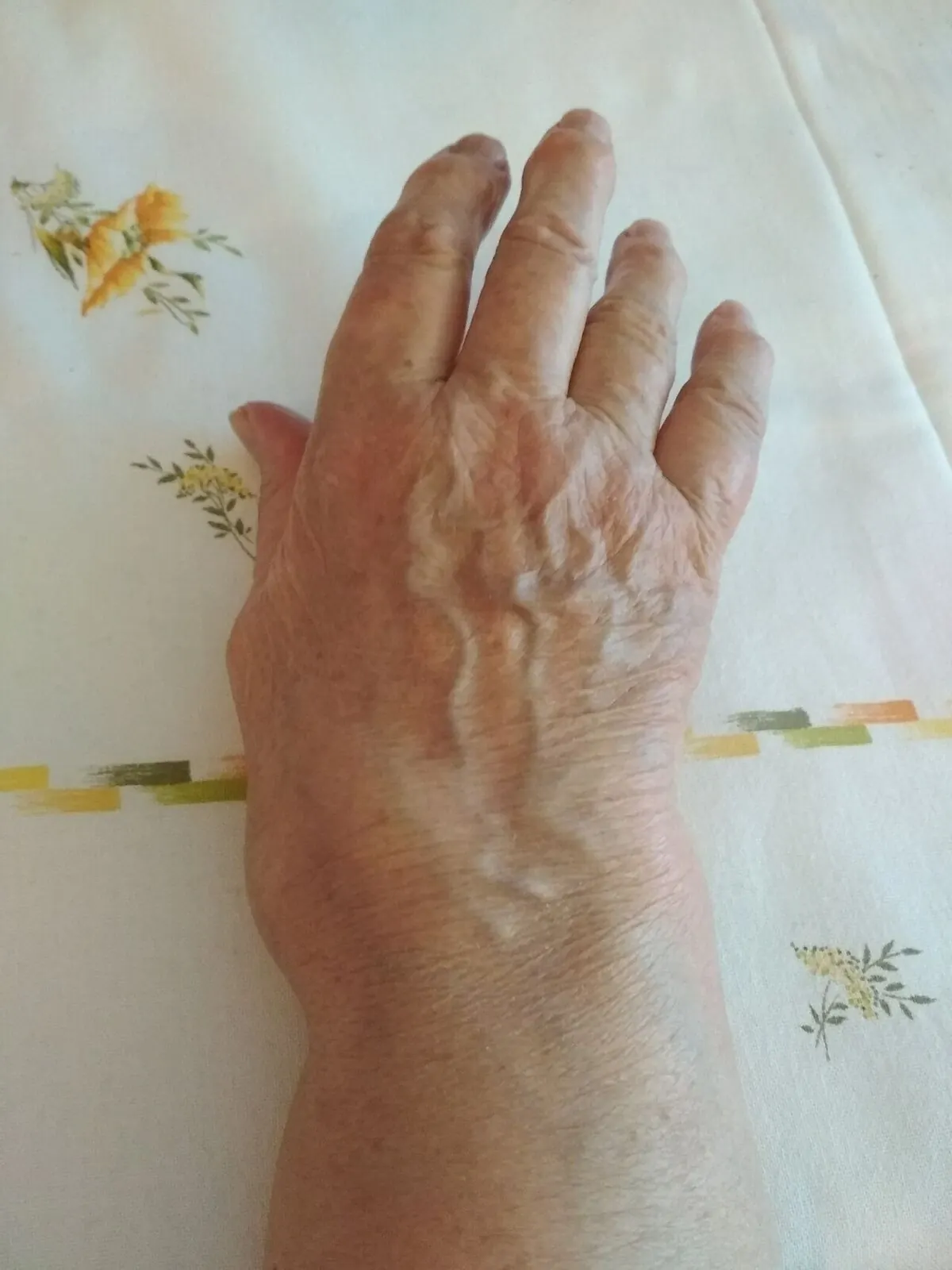 Rheumatoid arthritis hand changes