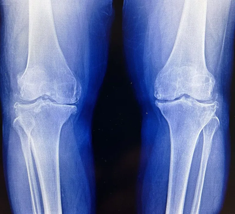 Knee OA x-ray evidence for PIP