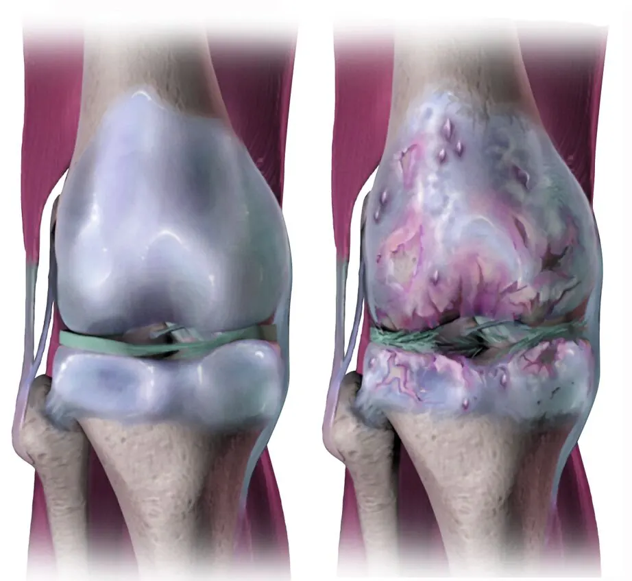 Gout attack joint inflammation